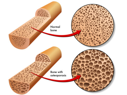 You are currently viewing Osteoporosis: Lets sort out the myths from the facts