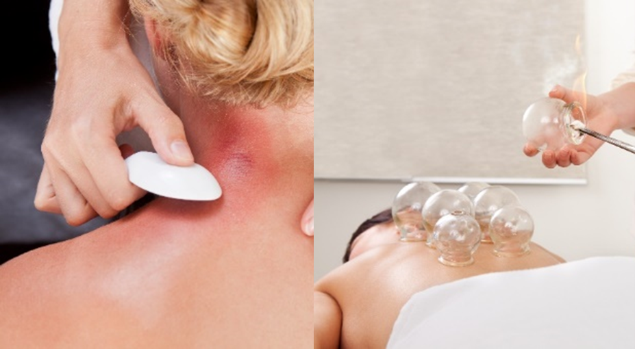 Read more about the article What is the difference between Cupping & Gua Sha?