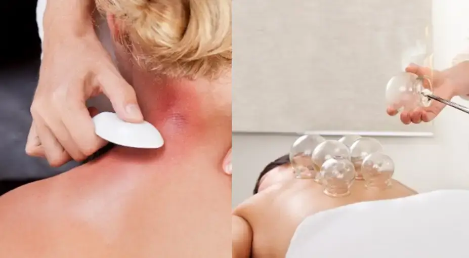 You are currently viewing What is the difference between Cupping & Gua Sha?