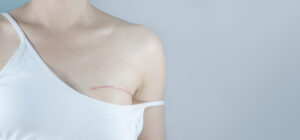 Read more about the article How to reduce post-operative scars