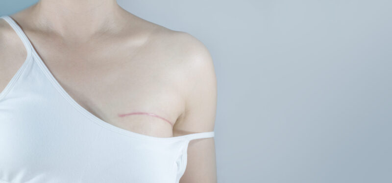mastectomy scar