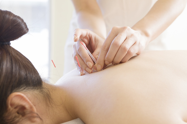 You are currently viewing Discover Rapid Pain Relief With Dry Needling and Osteopathy