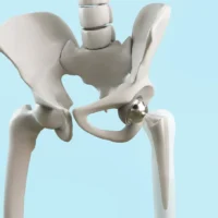 Been Told You Need a Hip Replacement?