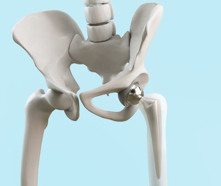 Hip Arthritis