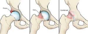 Read more about the article Femoral Acetabular Impingement