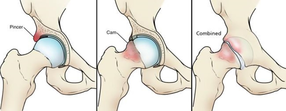 Hip Impingement Pain